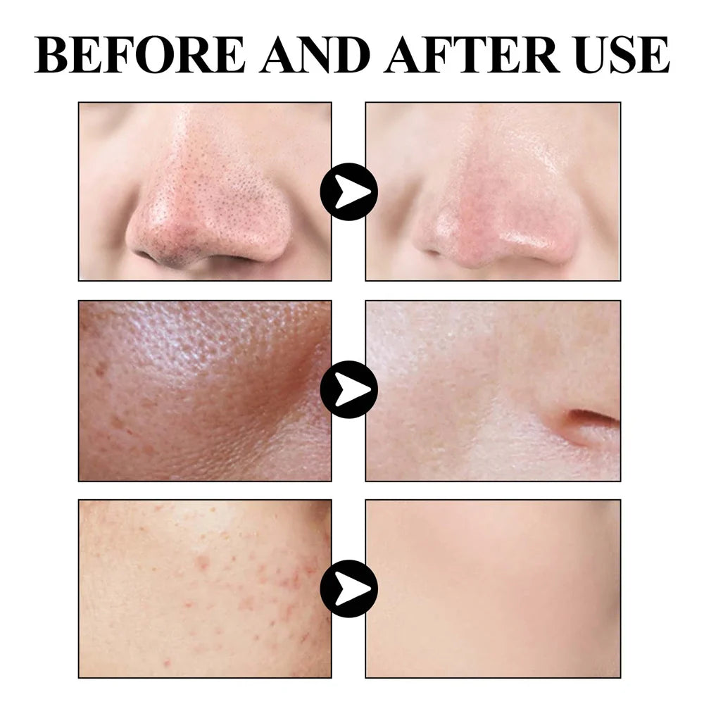 West Month Blackhead Mud Mask Oil Control Pore Cleansing Treatment